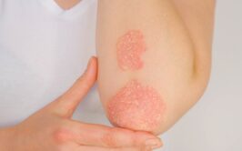 Identify Symptoms - Psoriasis