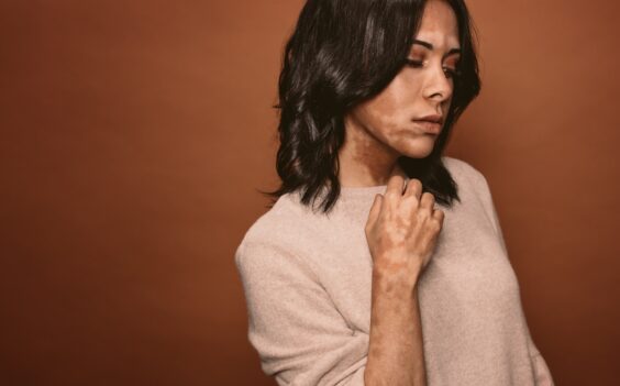 Identify Symptoms - Vitiligo
